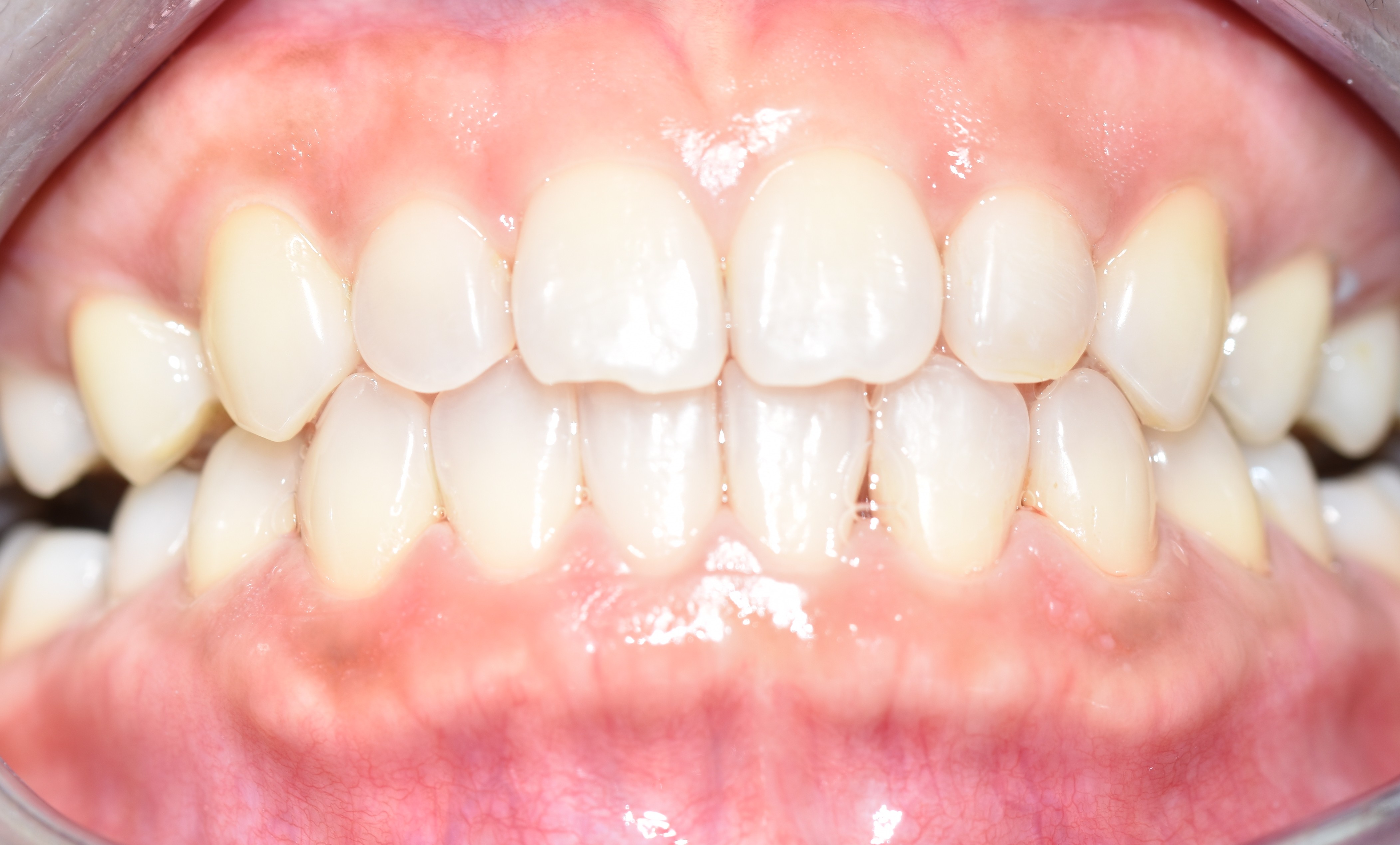 After treatment